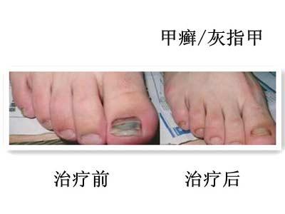 如何治疗灰指甲最有效 如何治疗灰指甲可减少痛苦？