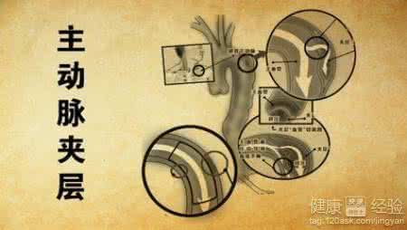 名医秘方精选推荐 一 名医秘方精选 转载 【转载】脑动脉硬化秘方