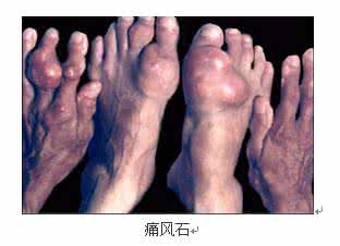 有治皮脂腺囊肿的药吗 皮脂腺囊肿 它的临床表现有哪些
