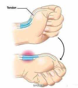 治腱鞘炎效果好的方法 腱鞘炎的自我诊断方法