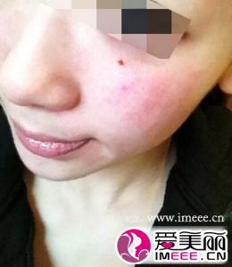 皮肤过敏症状有哪些 皮肤过敏症状有哪些 如何避免