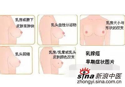 乳腺癌鉴别诊断 乳腺癌鉴别诊断 中医鉴别乳腺癌 乳腺癌与其他乳腺疾病的鉴别