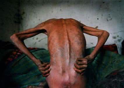 一滴血能感染艾滋病吗 新疆艾滋病 新疆艾滋病人滴血事件