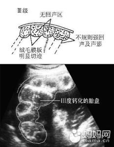 胎盘三级和老化的区别 胎盘老化 胎盘几级算出现了老化呢