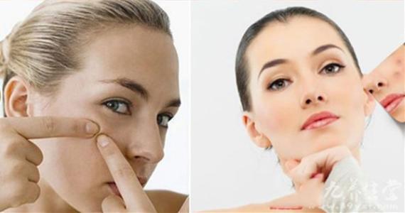 如何祛痘痘痘 祛痘有高招：怎样快速去痘痘