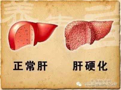 治疗肝硬化的民间秘方 国宝秘方:早期肝硬化半月见效痊愈不复发!