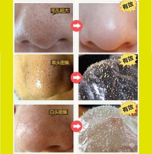 如何去粉刺收缩毛孔 如何去粉刺收缩毛孔 粉刺挤了之后怎么收缩毛孔
