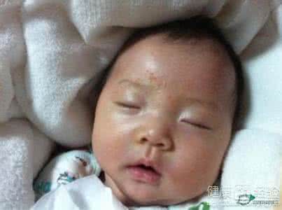 婴儿湿疹妈妈忌吃什么 婴儿湿疹妈妈吃什么好 治疗婴儿湿疹的方法那么多，妈妈从何下手