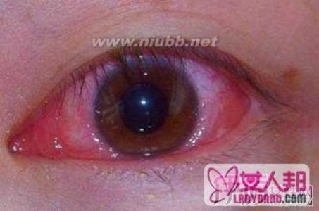 儿童结膜炎症状图片 结膜炎的症状图片 结膜炎的症状及治疗