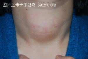桥本氏甲状腺炎的症状 桥本氏甲状腺炎症状 它的症状有哪些