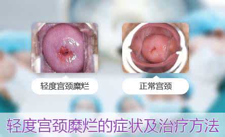 怎么预防宫颈糜烂 怎么预防宫颈糜烂 哪些方法可以预防宫颈糜烂