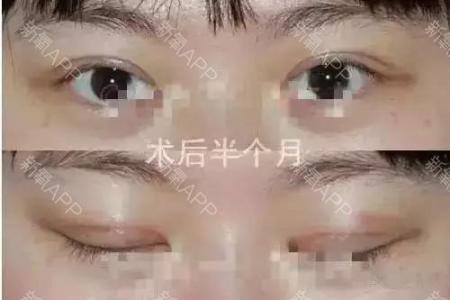 双眼皮手术张冰洁厉害 一张图让你看懂双眼皮手术