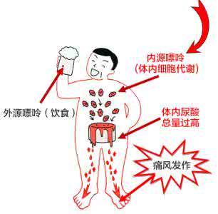 如何预防痛风 如何预防痛风 ？