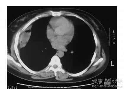 脓胸的治疗 小单治大病--治疗胸膜炎/脓胸