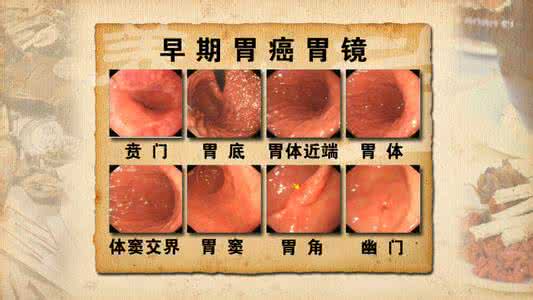 胃溃疡和胃癌的区别 胃癌和胃溃疡怎么区别