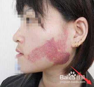 激光治疗鲜红斑痣 激光治疗鲜红斑痣 激光祛斑，轻松消灭8种斑痣