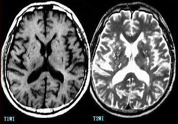 腔隙性脑梗死的治疗 腔隙性脑梗死 这样治疗腔隙性脑梗死比较好