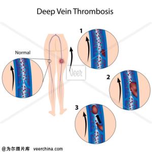 深静脉血栓形成原因 深静脉血栓 引起它的原因是什么