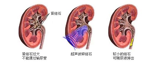 肾结石症状有哪些 肾结石症状 8招远离肾脏结石