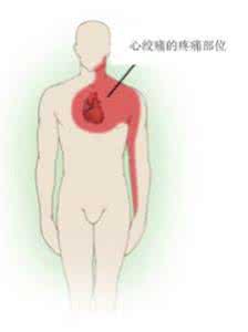心绞痛的原因怎么治疗 引起心绞痛的原因有哪些