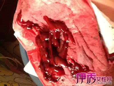 月经不正常的血块图片 月经有血块正常吗