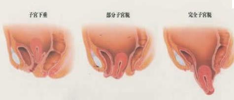 子宫下垂可以上环吗 子宫下垂能上环吗