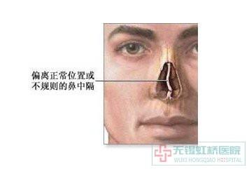 鼻出血的止血方法 鼻子出血怎么回事 鼻子出血怎么回事 鼻出血原因及防治法