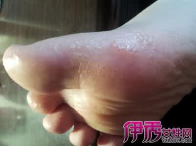 脚上磨出水泡怎么处理 脚上磨出水泡想快速好 脚上起水泡很痒怎么办?用什么药能快速止痒