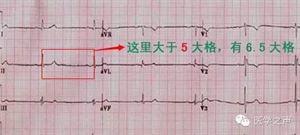 简简单单 看懂心电图 简简单单，看懂心电图