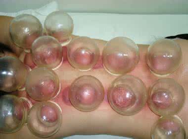 火罐减肥的副作用 拔火罐减肥的作用及功效