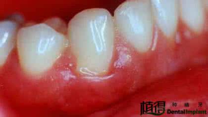 治疗牙周炎的民间秘方 【民间良方】治疗牙龈出血牙周炎秘方