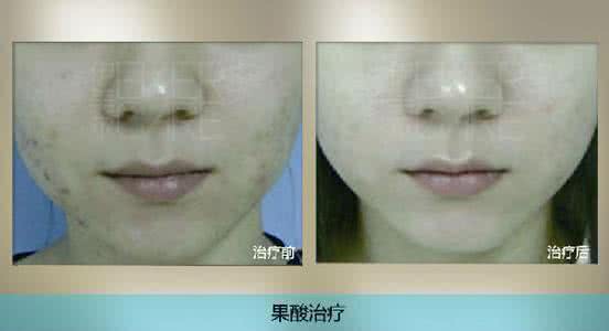 填补痘坑 化妆前填补痘坑怎么做 逆天化妆术,用假睫毛填补你的眉毛,太真实自然了