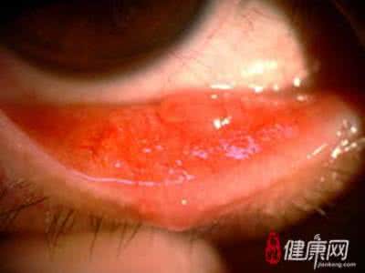 儿童过敏性结膜炎症状 儿童过敏性结膜炎症状 儿童过敏性结膜炎症状有哪些