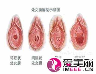 女处女膜图 处女膜修复手术简介