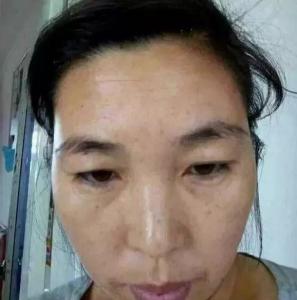去除块状斑的办法 脸上长块状斑怎么办 脸上长块状斑怎么办 去除脸上斑点安全可靠的方法