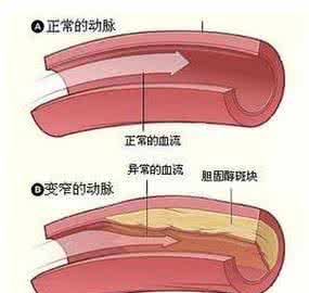 疏通血管的食物 血管硬化不用怕，几种食物帮您疏通清理血管、软化血管硬化