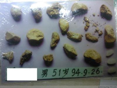 治疗肾结石的秘方 治疗各种结石的秘方你有吗—