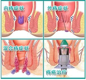 标本兼治 15分钟标本兼治，从根源上祛除痔疮