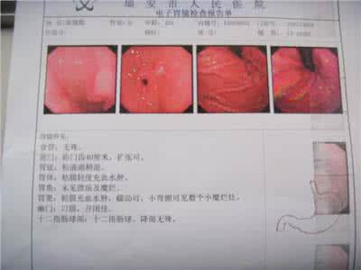 胃窦部糜烂 【胃窦部糜烂】