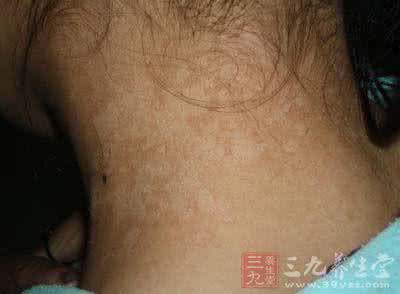 皮肤长汗斑 夏季防汗斑 两种方法让你皮肤焕然一新