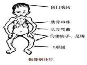 维生素d缺乏性佝偻病 维生素D缺乏性佝偻病 有哪些治疗方法