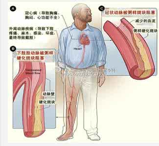 心血管疾病危险因素 如何保护心血管 4危险因素引发心血管疾病