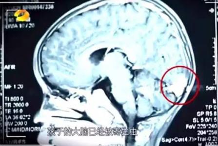 孩子肺部和脑部被吃空！体内5000条寄生虫！竟是因为这个习惯…