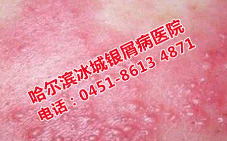 治疗湿疹最快偏方大全 湿疹好治吗