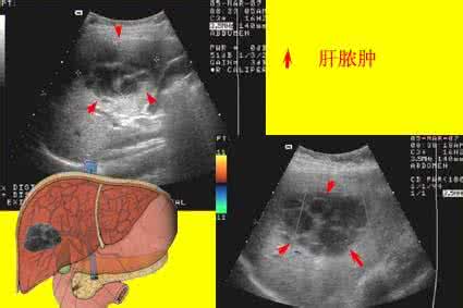 肝脓肿严重吗 肝脓肿