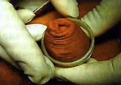 包茎手术要挂什么科 切割包皮手术挂什么科?