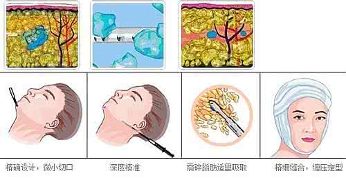 面部吸脂恢复过程图 面部吸脂手术 面部吸脂手术过程