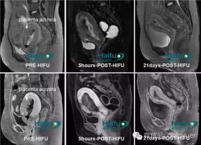 胎盘植入几个月最危险 胎盘植入的治疗方法