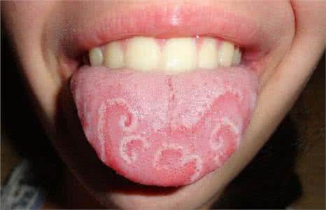 脑胶质瘤中医治疗偏方 小儿地图舌的治疗 推荐2个中医偏方