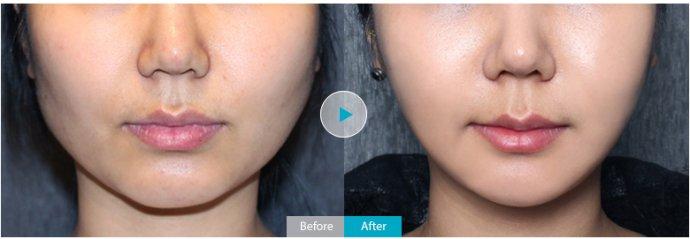 做磨骨瘦脸手术多少钱 瘦脸手术 哪些人不能做瘦脸手术